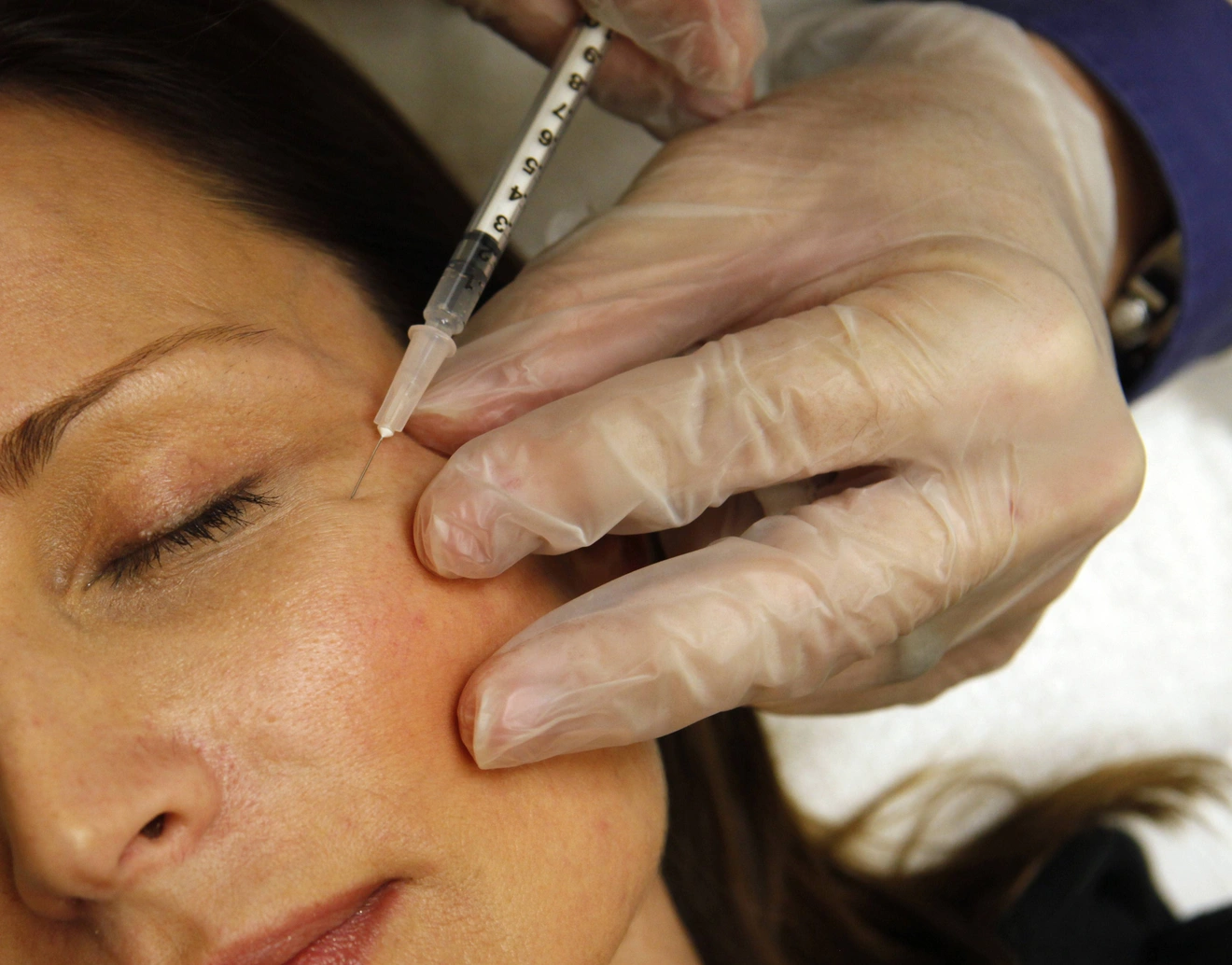 botox