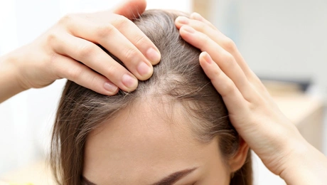 alopekia