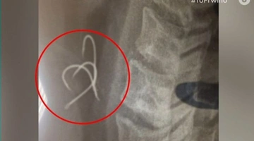 38χρονος κατάπιε αγκίστρια τρώγοντας χταπόδι