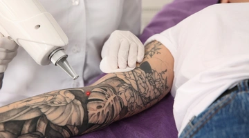 Tattoo removal